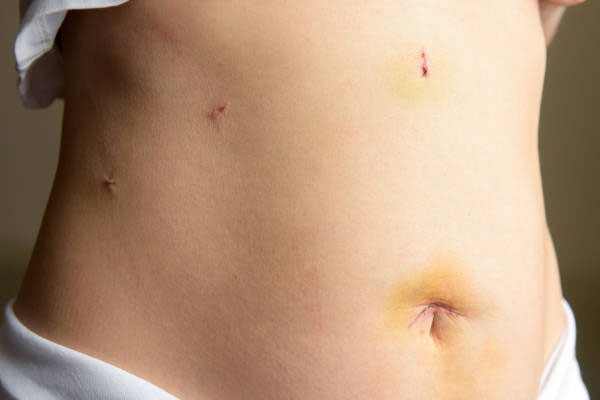 Cicatrizacion laparoscopia