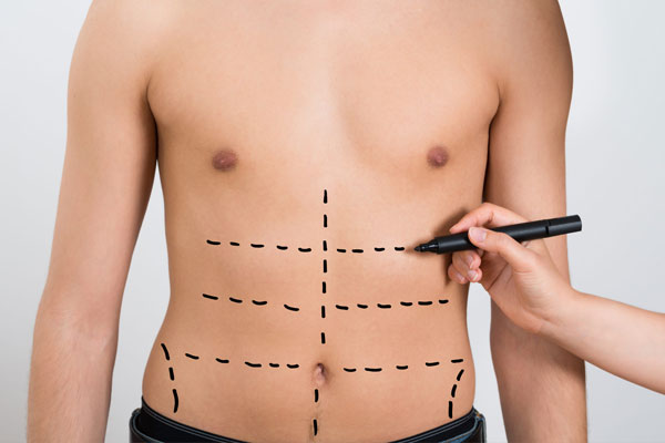 Cicatrizacion pared abdominal