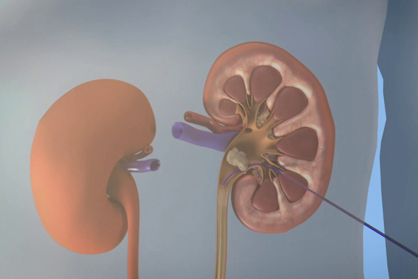 Cirugia Percutanea Renal​