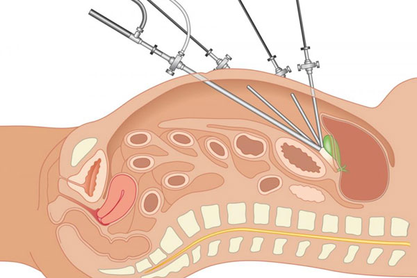 laparoscopia